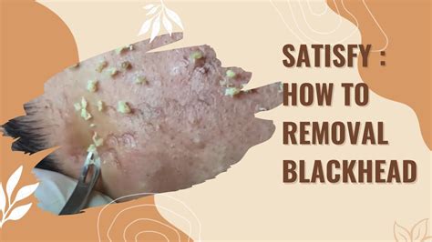 why is blackhead removal satisfying